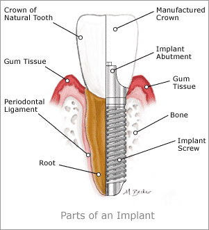 Diagram of dental implants from Greeley, CO
